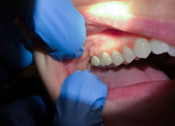 Best Emergency Dental Surgery in West Glens Falls, NY