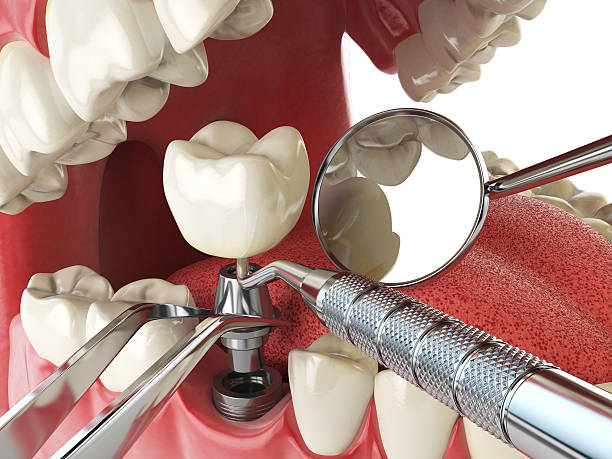 Best Emergency Wisdom Teeth Removal in West Glens Falls, NY